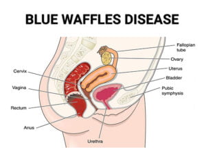 Is Blue Waffles Disease Real? What a Gynecologist Thinks - Century