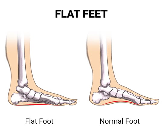 Flat Feet