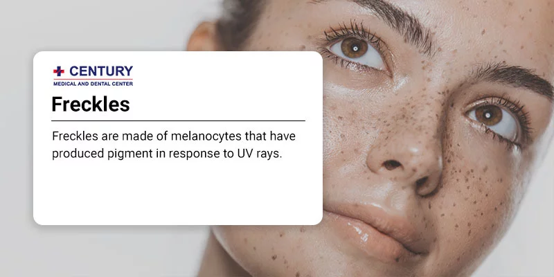 How to Tell the Difference Between a Mole and a Freckle