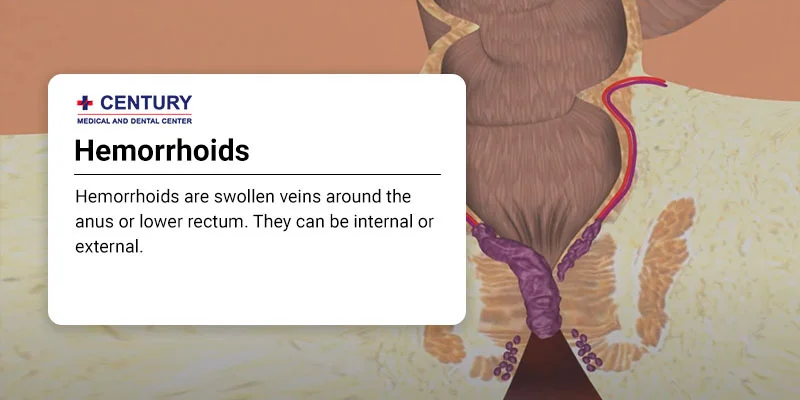 Hemorrhoids