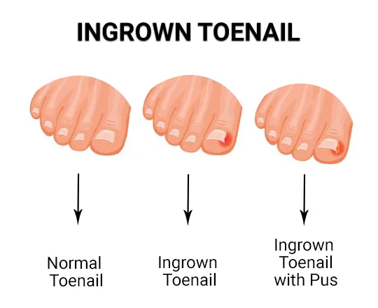 Potential Causes of Longitudinal Ridging