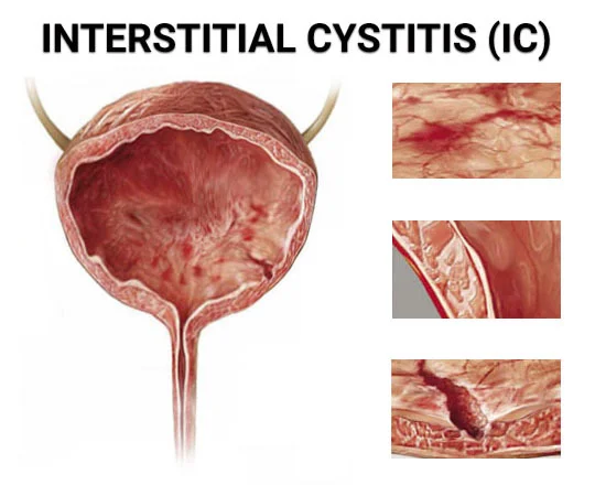 Can Mold Toxicity Cause IC & Urinary Symptoms? Yes! - Interstitial