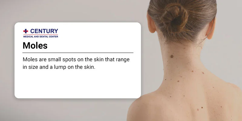 How to Tell the Difference Between a Mole and a Freckle - Century Medical & Dental Center How to Tell the Difference Between a Mole and a Freckle - Century Medical & Dental Center