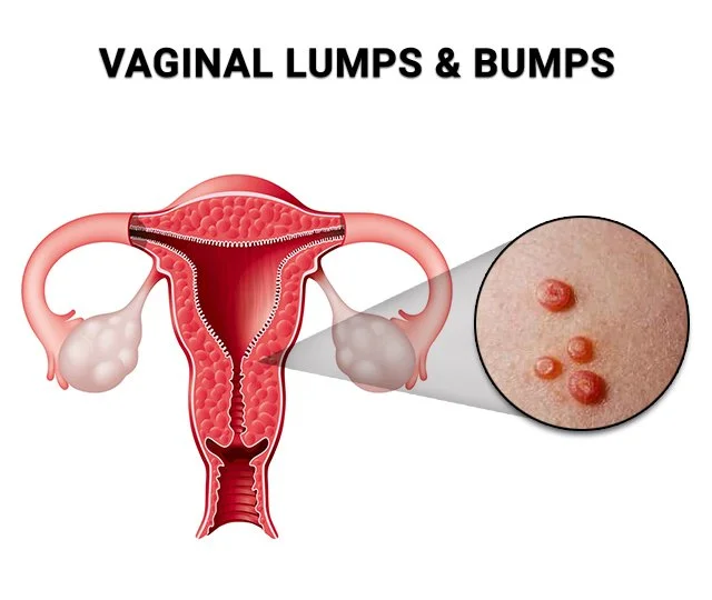 Vaginal Lumps and Bumps