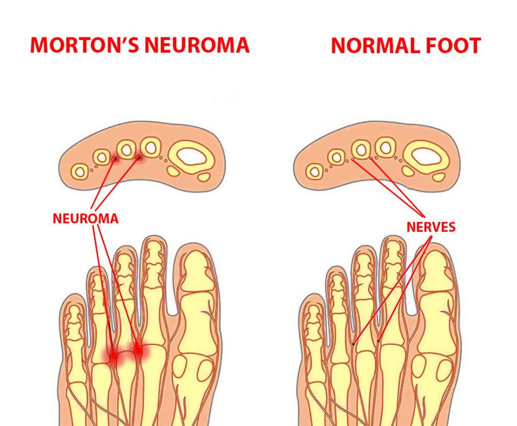 Morton’s Neuroma Symptoms and Treatment Century Medical & Dental Center