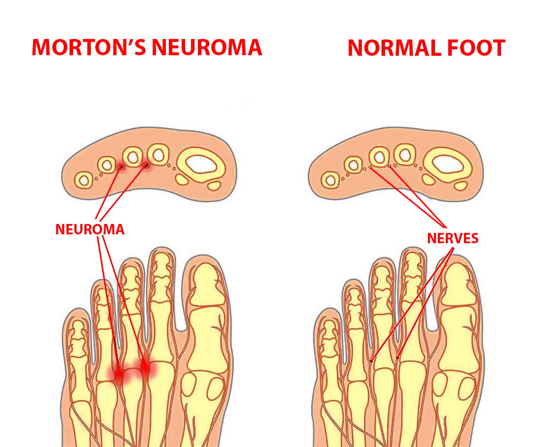 Morton’s Neuroma Symptoms and Treatment