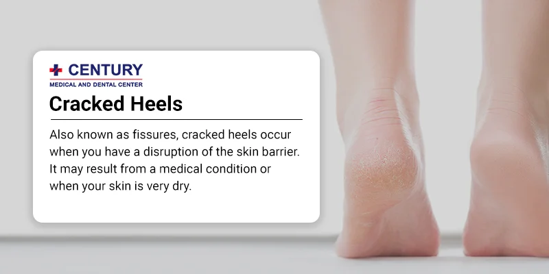 How to avoid cracked heels during Adelaide's hot summers