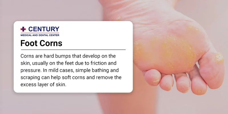 5 Quick Ways to Remove Hard Foot Skin, Corns and Calluses