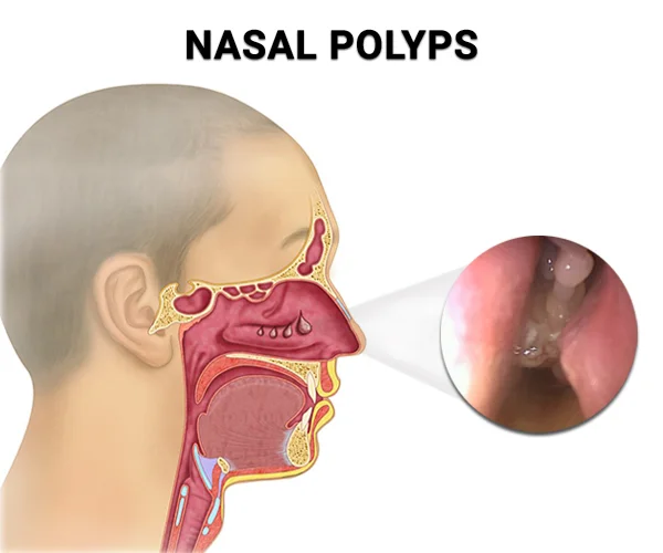 Sinus discount infection smell