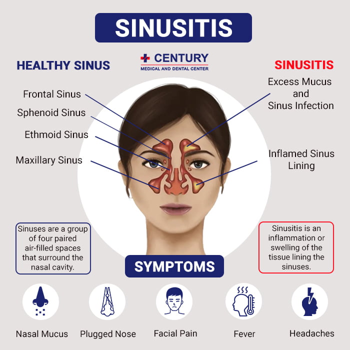 Are sinus infections contagious century medical dental center