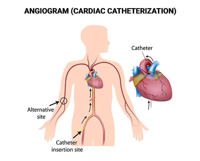 Angiogram