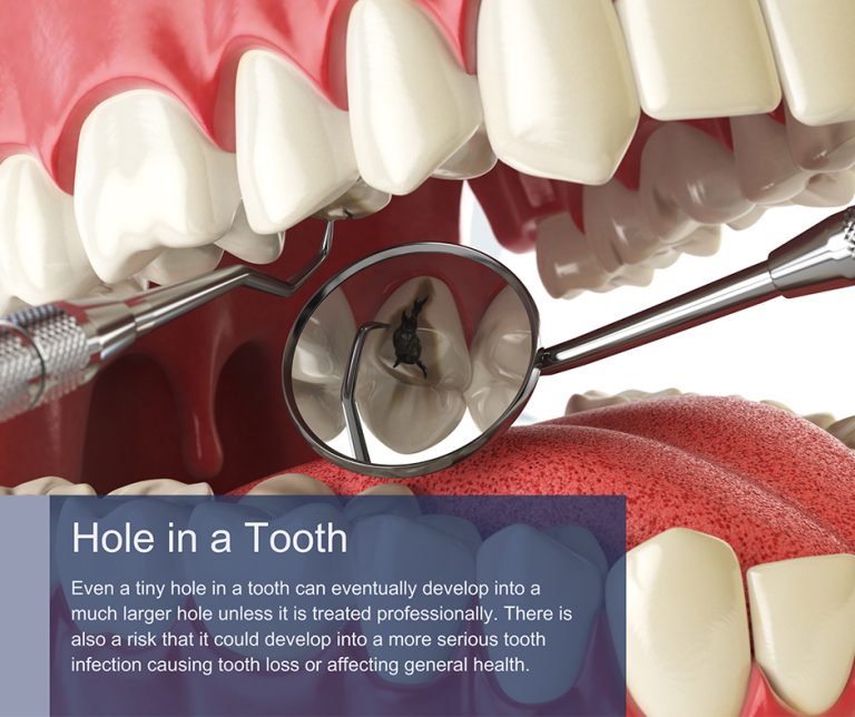 Hole in Tooth Treatment in Manhattan & Brooklyn, NY