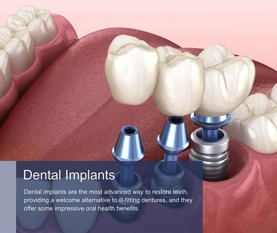 Implants Dental Near Me East Rockaway, NY