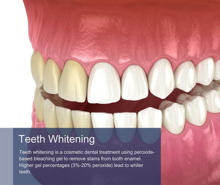 Teeth Whitening NYС | Best Teeth Whitening Dentist in Midtown Manhattan ...