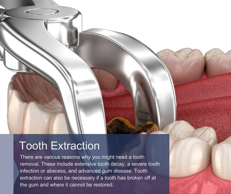 Tooth Extractions in Manhattan & Brooklyn, NY | Wisdom Teeth Removal