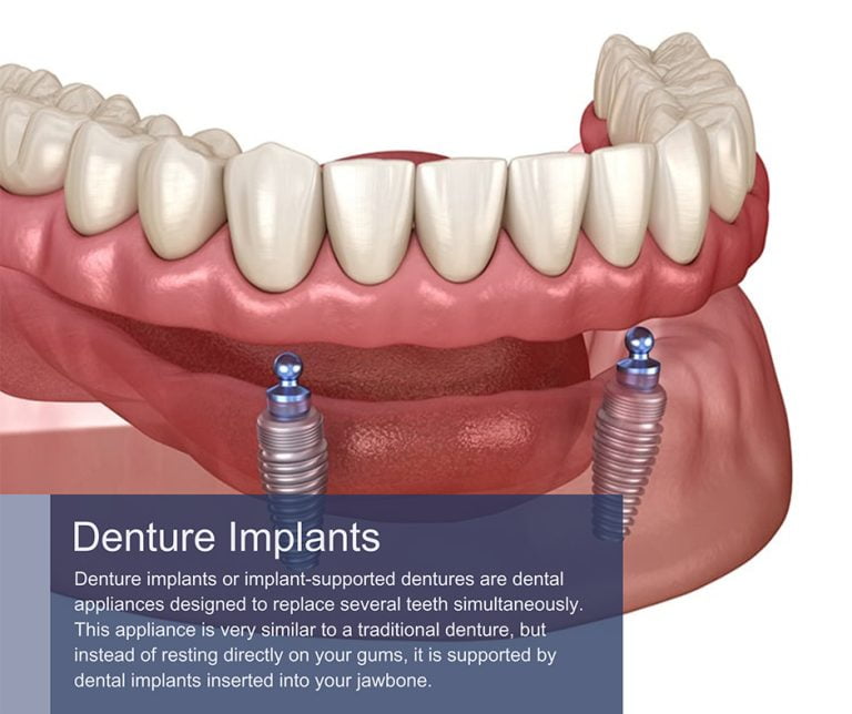 Denture Implants in Manhattan & Brooklyn, NY Dental Implants for Dentures