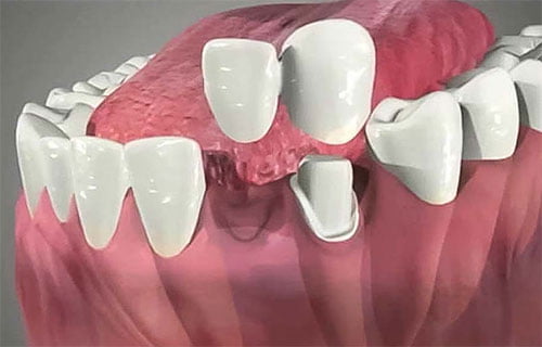 Cantilever Dental Bridge Midtown Manhattan and Brooklyn NY