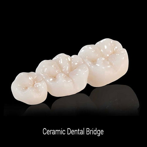 Ceramic Dental Bridge
