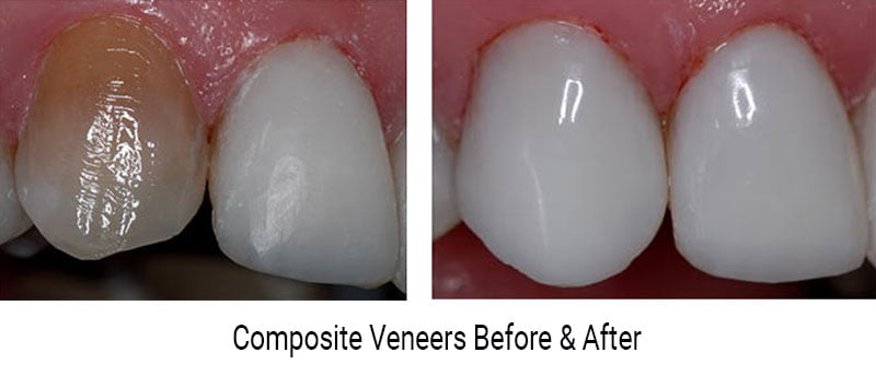 Composite Veneers Before After