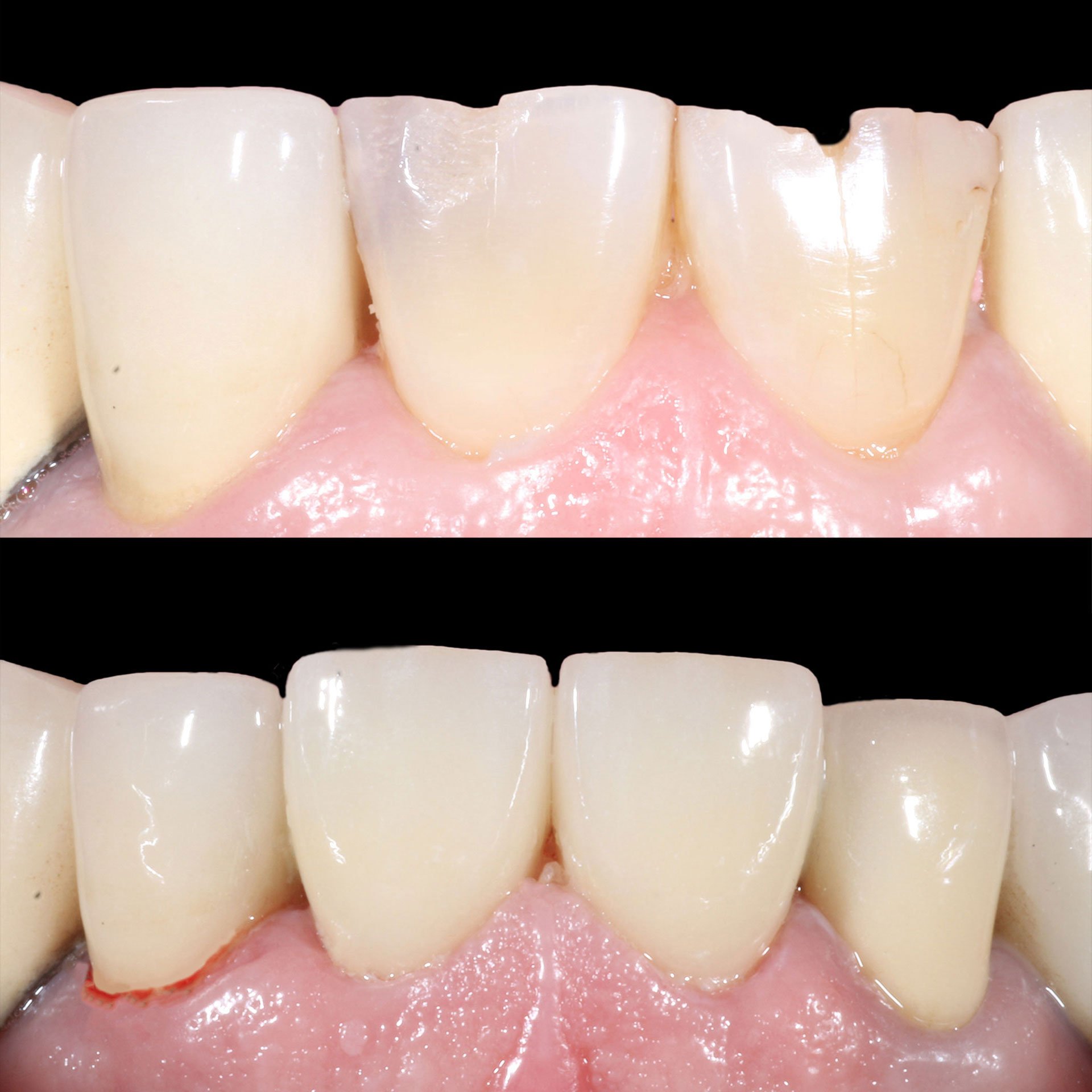 Dental Bonding Midtown Manhattan and Brooklyn NY - Before and After