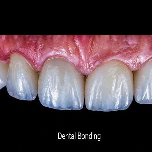 Dental Bonding