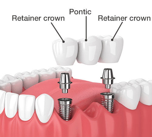 Implant-Supported Bridge Midtown Manhattan and Brooklyn NY