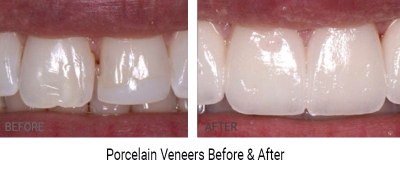 Porcelain Veneers Before After