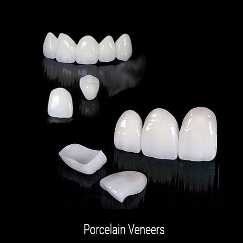 Porcelain Veneers