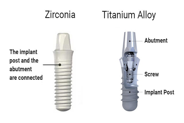 Titanium Alloy vs Zirconia Dental Implants