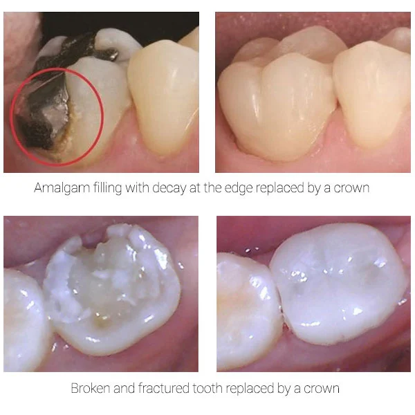 Restore decayed or damaged tooth with a dental crown
