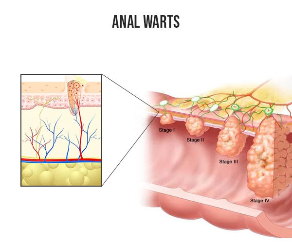 Anatomía de las verrugas anales