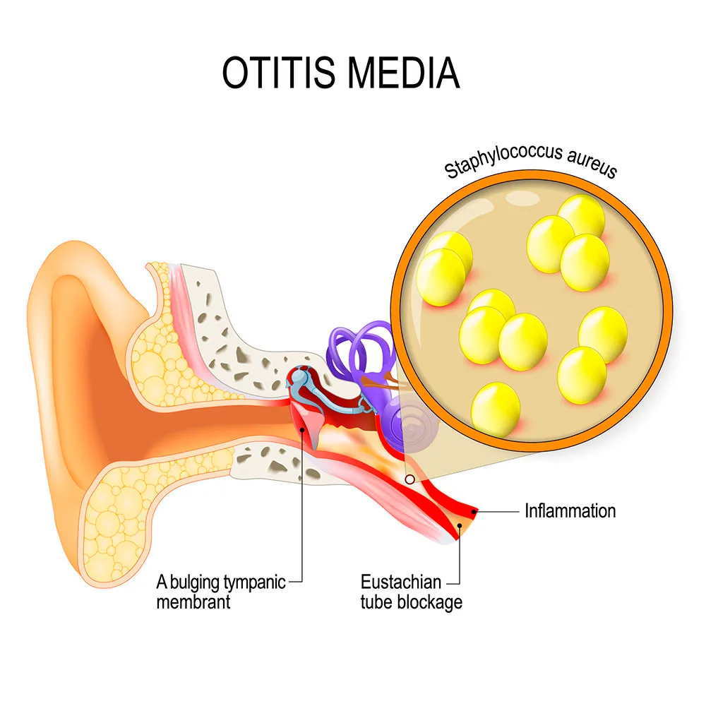 Otitis Media