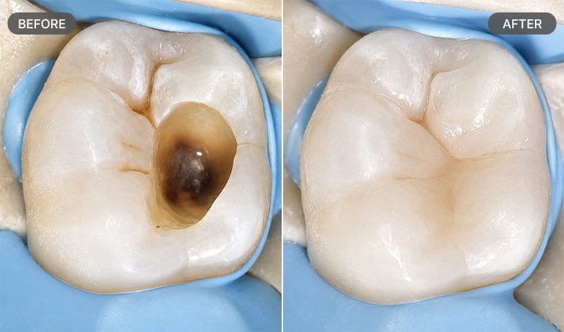 Cavity Filling Before After Tooth Decay Restoration