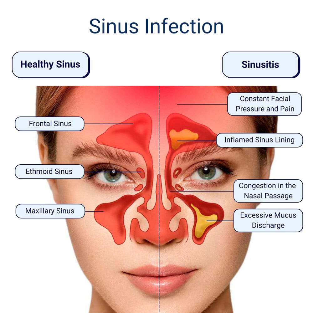 Sinus Infection Treatment in Harlem, Manhattan, Brooklyn