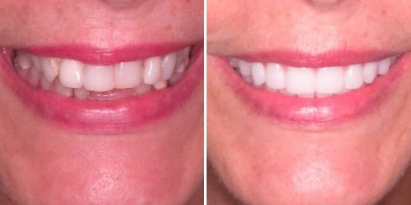 Cosmetic Dentistry Before After Results Case 5