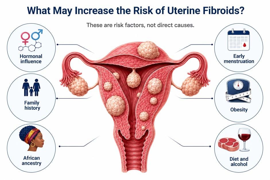 Medical infographic showing uterine fibroids and six associated risk factors: hormonal influence, family history, African ancestry, early menstruation, obesity, and diet and alcohol.